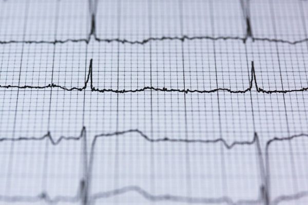 EKG Interpretation im Notfall