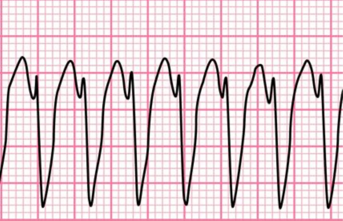EKG-Streifen mit tachykardem Rhythmus