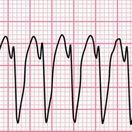 EKG-Streifen mit tachykardem Rhythmus