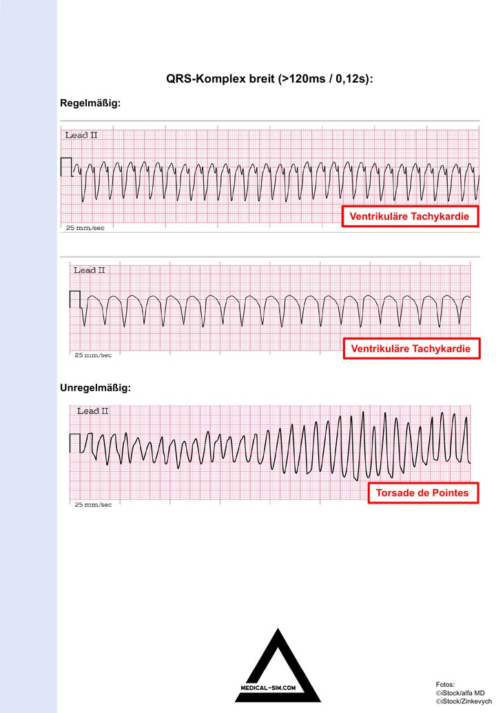 Visualisierungshilfe zum Audioprogramm Tachykardie – EKG-Beispiele bei breitem QRS-Komplex